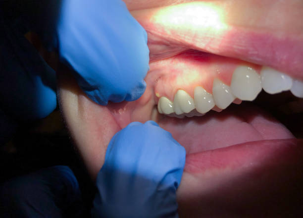 Best Dental Abscess Treatment in Nixon, PA